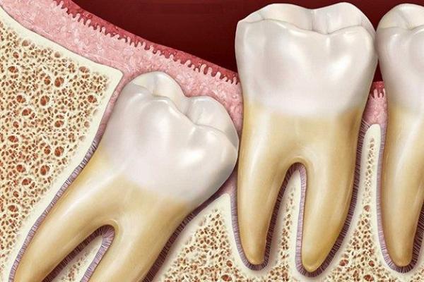 Нужно ли удалять зубы мудрости: зачем и в каких случаях удаляют