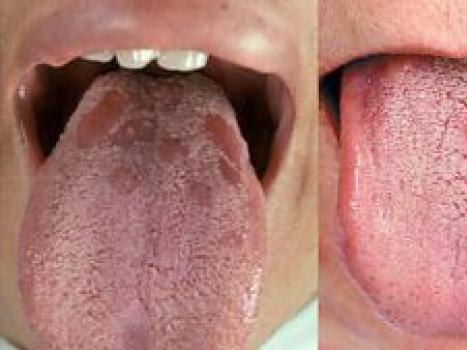 Сифилис полости рта — причины, симптомы, диагностика и лечение