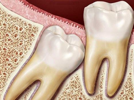Нужно ли удалять зубы мудрости: зачем и в каких случаях удаляют